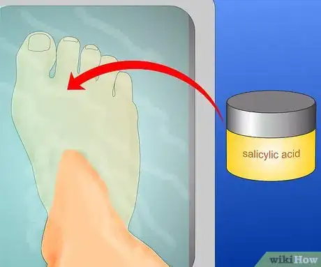 Obrázek nazván Get Rid of Warts Step 2