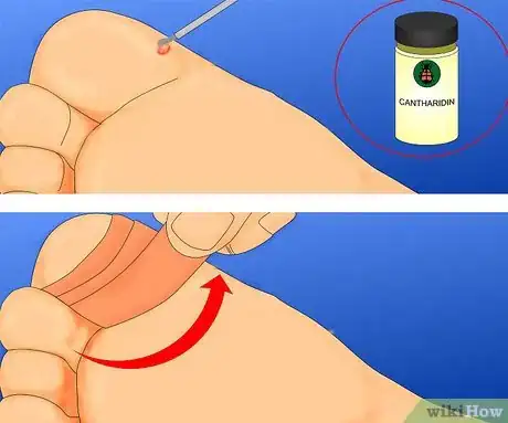 Obrázek nazván Get Rid of Warts Step 3