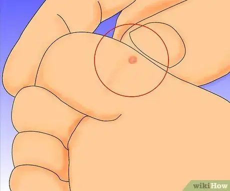 Obrázek nazván Get Rid of Warts Step 1