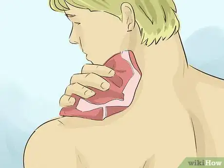 Obrázek nazván Remove a Hickey Step 2