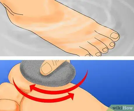 Obrázek nazván Get Rid of Warts Step 30