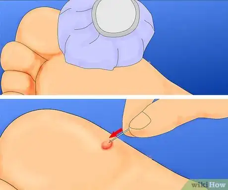 Obrázek nazván Get Rid of Warts Step 10