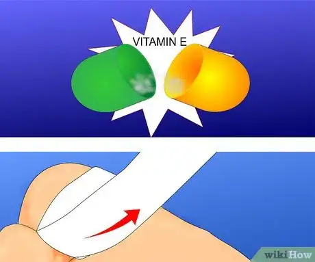 Obrázek nazván Get Rid of Warts Step 14