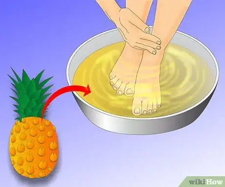 Obrázek nazván Get Rid of Warts Step 26