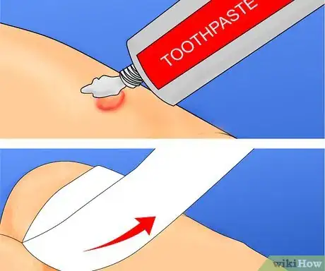 Obrázek nazván Get Rid of Warts Step 21