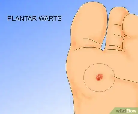 Obrázek nazván Get Rid of Warts Step 37Bullet3