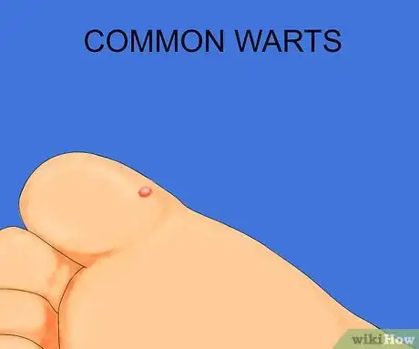 Obrázek nazván Get Rid of Warts Step 37Bullet1